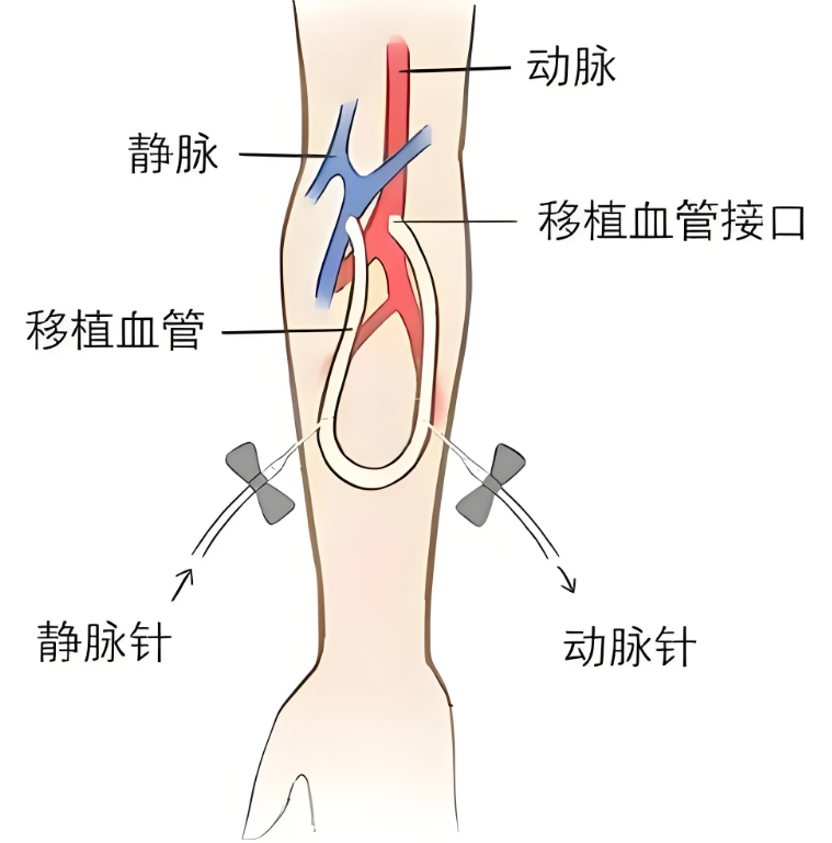 内瘘堵了揉一揉就行？大错特错！这些危害很多人不知道