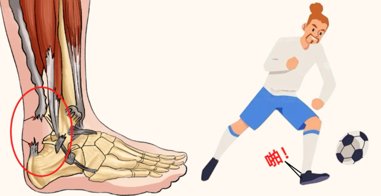 后跟上方隐隐疼？别不当回事！拖久了可能是跟腱断裂